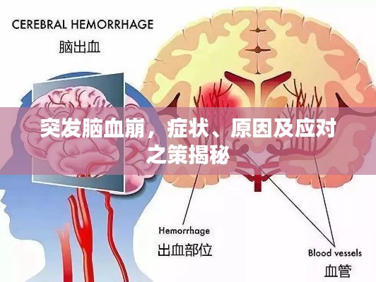 突发脑血崩，症状、原因及应对之策揭秘