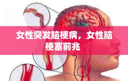 女性突发脑梗病,女性脑梗塞前兆
