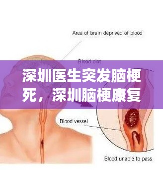 深圳医生突发脑梗死,深圳脑梗康复医院